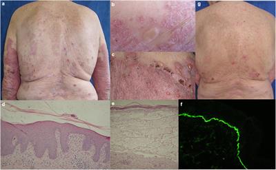 Case Report: Coexistence of bullous pemphigoid and psoriasis: Therapeutic challenge and IL17A-targeted parallel treatment strategy